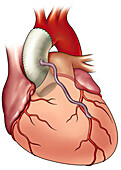 Ascending aorta graft with coronary artery bypass, illustration