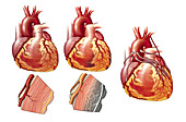 Myocardial infarction, illustration