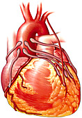 Multiple coronary artery bypasses, illustration