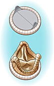 Aortic valve replacements, illustration