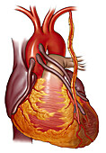 Heart attack with bypass, illustration
