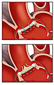 Aortic valve replacement, illustration