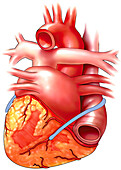 Saphenous vein graft, illustration