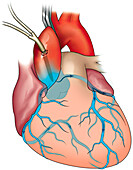 Cardiac angiogram, illustration