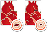 Poor aortic valve function, illustration