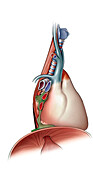 Mediastinal abscess, lateral view, illustration