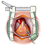 Bypass surgery, illustration