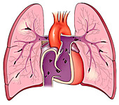 Pulmonary emboli shower, illustration