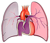Saddle embolus with lung infarction, illustration