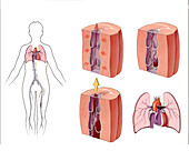 Deep vein thrombosis, illustration