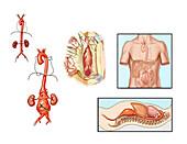 Abdominal aortic aneurysm, illustration