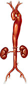 Thoracic aortic aneurysm, illustration