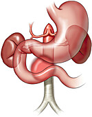 Midabdominal aneurysm above aortic graft, illustration