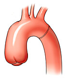 Thoracic aorta showing suture line, illustration