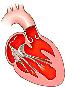 Hypoplastic left heart syndrome, illustration