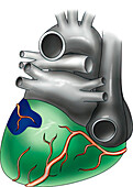 Heart showing area of infarction, illustration
