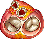 Mitral and aortic valve incompetence, illustration