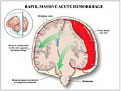 Massive acute subdural haematoma, illustration