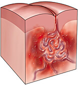 Arteriovenous malformation, illustration