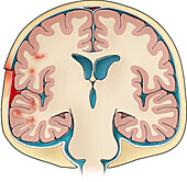 Skull fracture with subdural haematoma , illustration