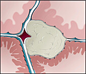 Meningioma brain tumour, illustration