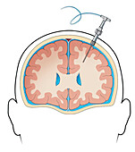 Measuring intracerebral pressure, illustration