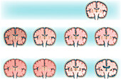 Anoxic brain injury, illustration