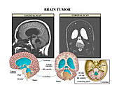 Imaging of brain tumour, illustration