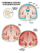 Cerebral oedema with herniation, illustration