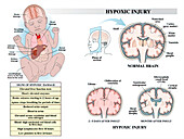 Hypoxic brain injury, illustration