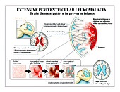 Periventricular leukomalacia, illustration