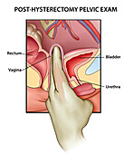 Post-hysterectomy pelvic exam, illustration