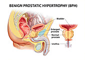 Benign prostatic hypertrophy, illustration