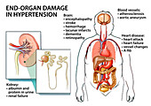 End-organ damage from hypertension, illustration