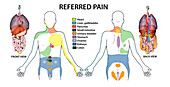 Referred pain, illustration