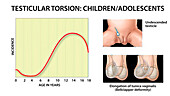 Testicular torsion in children, illustration