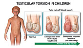 Testicular torsion in children, illustration