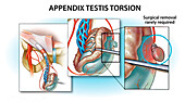 Appendix testis torsion, illustration