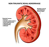 Non-traumatic renal haemorrhage, illustration