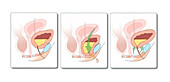 Stress urinary incontinence, illustration