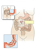Temporary colostomy, illustration