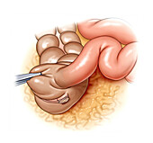 Appendicitis, illustration