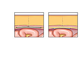 Ventral hernia repair, illustration