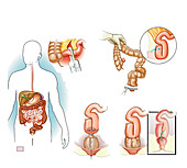 Total colectomy with J-pouch formation, illustration