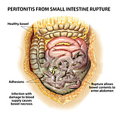 Peritonitis from ruptured bowel, illustration