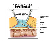 Ventral hernia, illustration