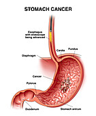 Stomach cancer with esophagoscope, illustration