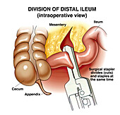 Division of distal ileum, illustration