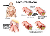 Bowel perforation, illustration