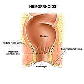 Haemorrhoids, illustration